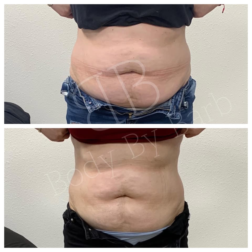 Lipo Xtreme Fat Dissolve