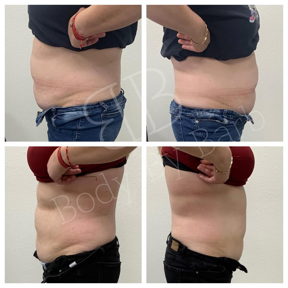Lipo Xtreme Fat Dissolve